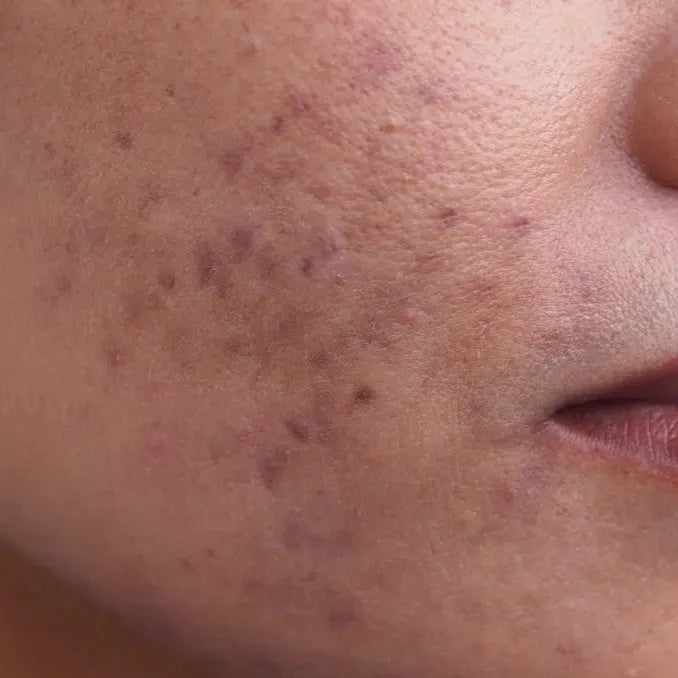 white woman forehead with hyperpigmentation dermal essentials medical grade skincare
