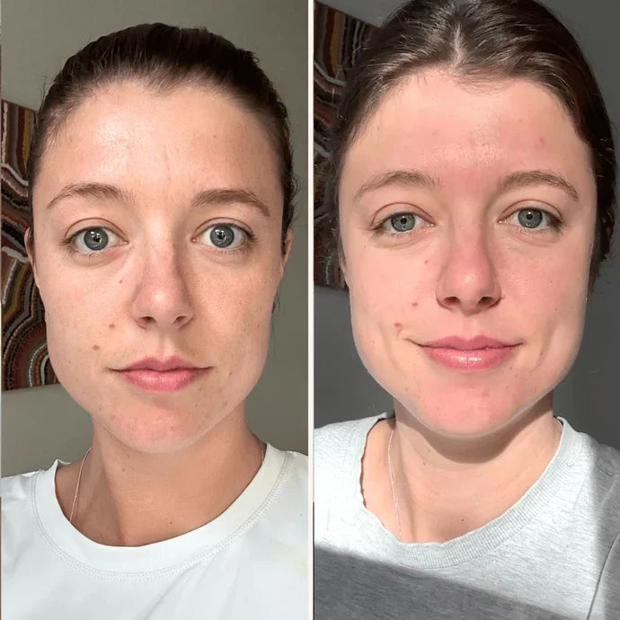 Trudermal Microneedling Infusion Kit - Exquisite Laser Clinic